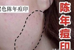 有效去除痘印的秘诀，告别肌肤烦恼，重拾自信光彩