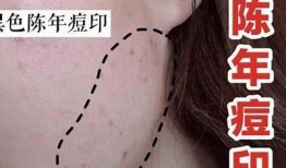 有效去除痘印的秘诀，告别肌肤烦恼，重拾自信光彩