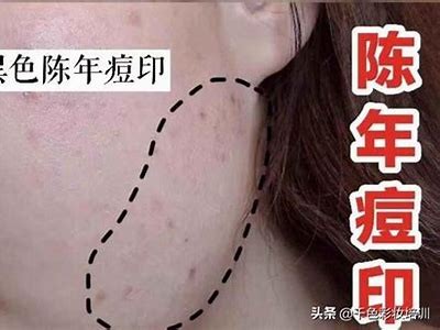 有效去除痘印的秘诀，告别肌肤烦恼，重拾自信光彩